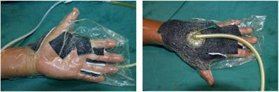 Clinical study of early rehabilitation training combined with negative pressure wound therapy for the treatment of deep partial-thickness hand burns